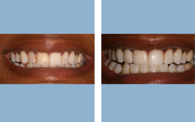 Before and After